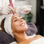Derma Pen facial en Valencia