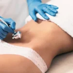 Derma Pen corporal en Valencia