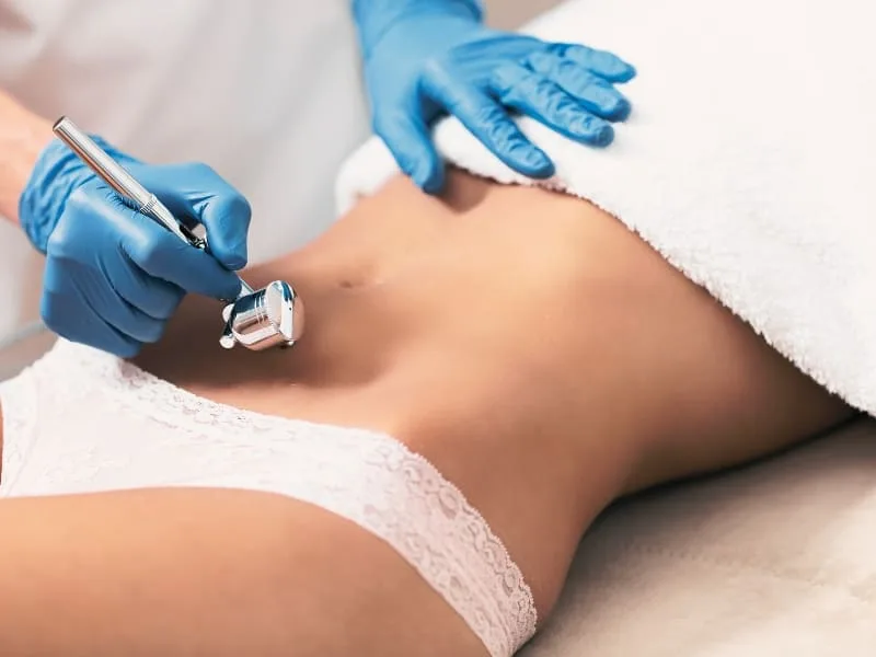 Derma Pen corporal en Valencia